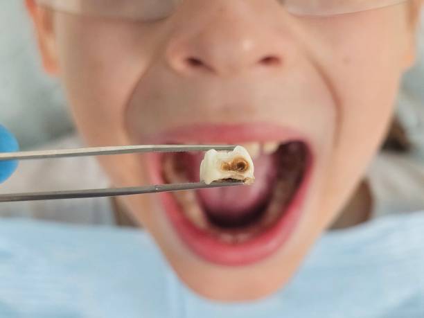 Best Emergency Tooth Extraction in Broad Brook, CT